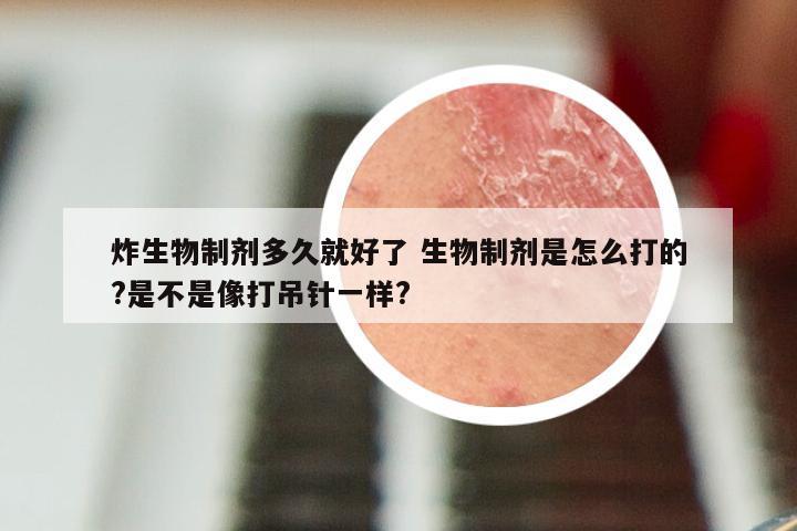 炸生物制剂多久就好了 生物制剂是怎么打的?是不是像打吊针一样?