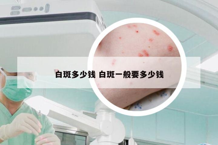 白斑多少钱 白斑一般要多少钱