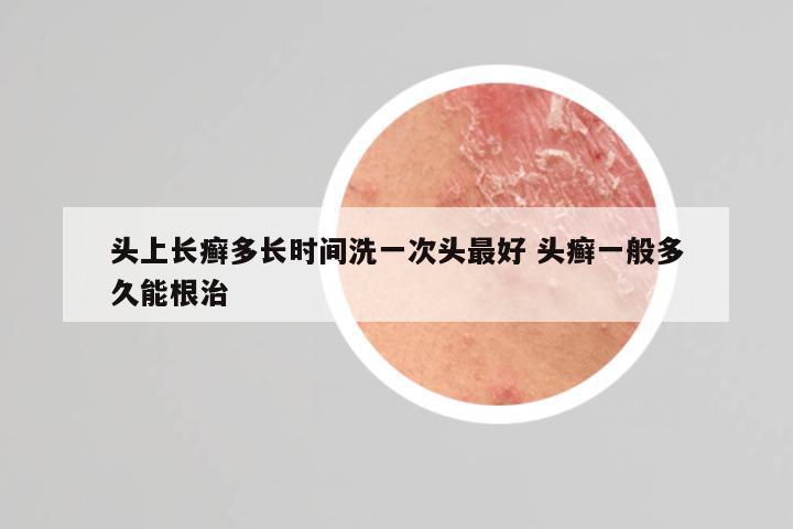 头上长癣多长时间洗一次头最好 头癣一般多久能根治