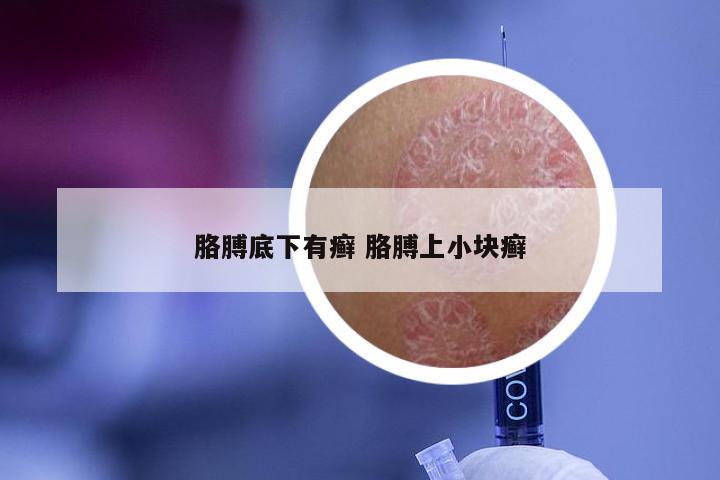 胳膊底下有癣 胳膊上小块癣