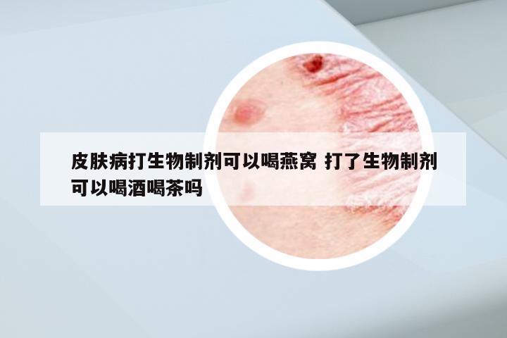 皮肤病打生物制剂可以喝燕窝 打了生物制剂可以喝酒喝茶吗