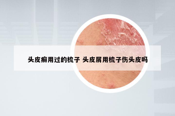 头皮癣用过的梳子 头皮屑用梳子伤头皮吗