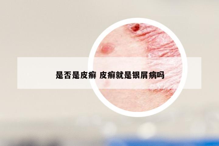 是否是皮癣 皮癣就是银屑病吗