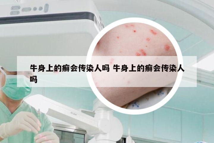 牛身上的癣会传染人吗 牛身上的癣会传染人吗