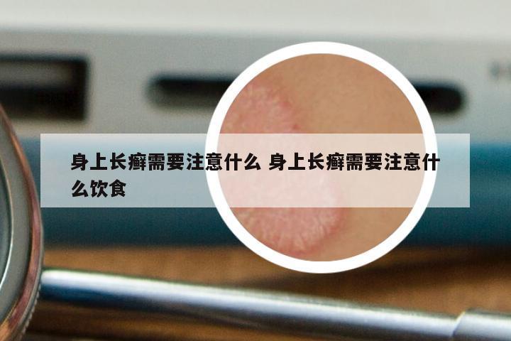 身上长癣需要注意什么 身上长癣需要注意什么饮食