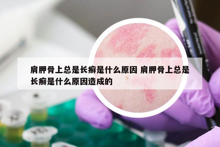 肩胛骨上总是长癣是什么原因 肩胛骨上总是长癣是什么原因造成的