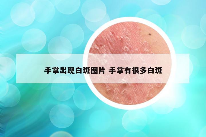 手掌出现白斑图片 手掌有很多白斑