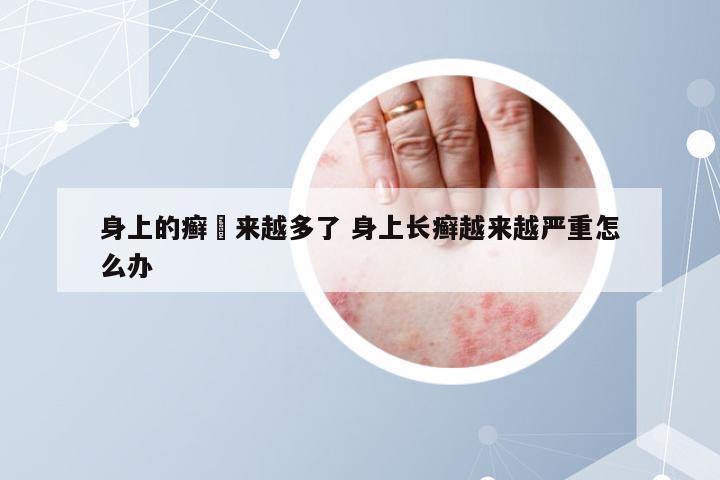 身上的癣趉来越多了 身上长癣越来越严重怎么办