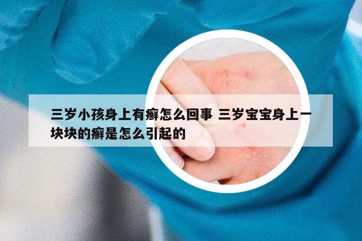 三岁小孩身上有癣怎么回事 三岁宝宝身上一块块的癣是怎么引起的