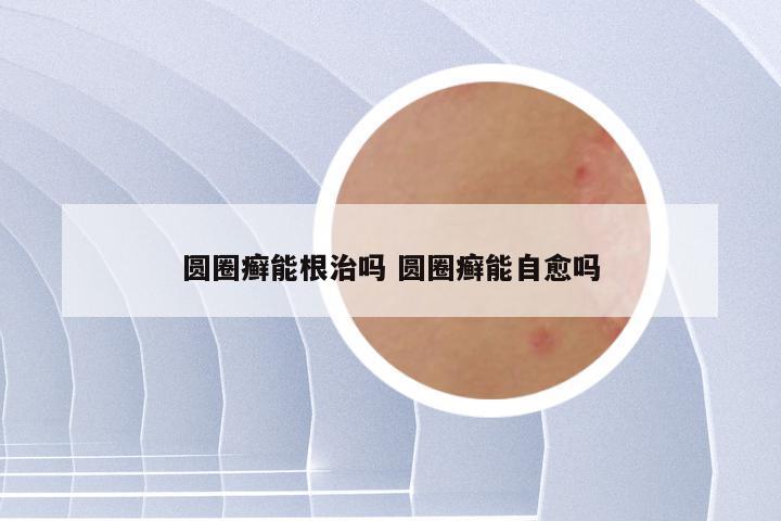 圆圈癣能根治吗 圆圈癣能自愈吗