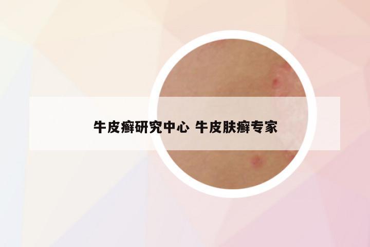 牛皮癣研究中心 牛皮肤癣专家