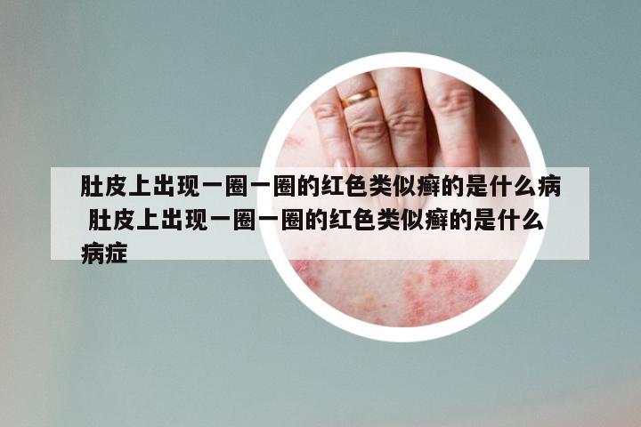 肚皮上出现一圈一圈的红色类似癣的是什么病 肚皮上出现一圈一圈的红色类似癣的是什么病症