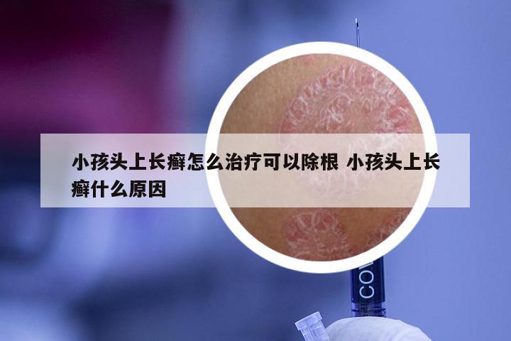 小孩头上长癣怎么治疗可以除根 小孩头上长癣什么原因