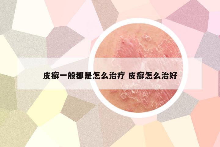 皮癣一般都是怎么治疗 皮癣怎么治好