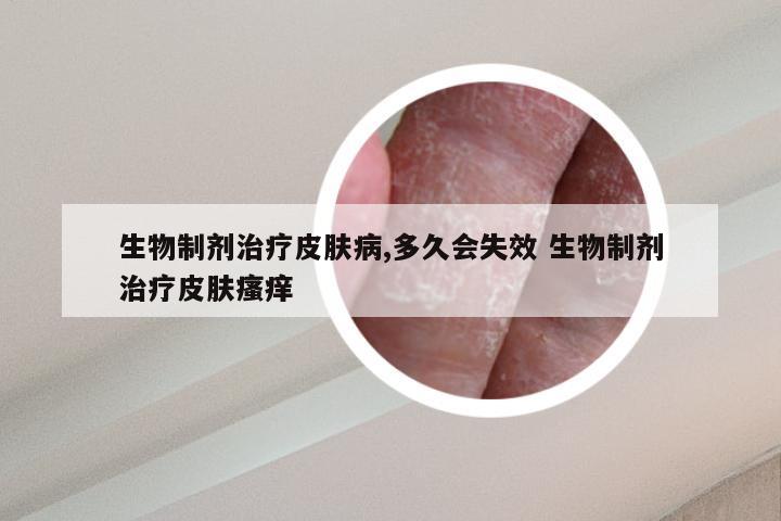 生物制剂治疗皮肤病,多久会失效 生物制剂治疗皮肤瘙痒