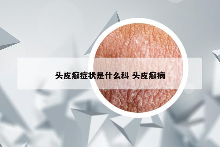 头皮癣症状是什么科 头皮癣病