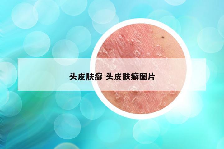 头皮肤癣 头皮肤癣图片