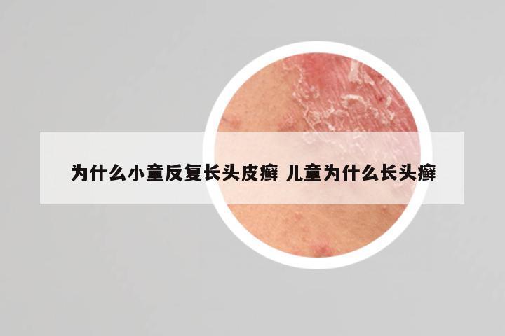 为什么小童反复长头皮癣 儿童为什么长头癣