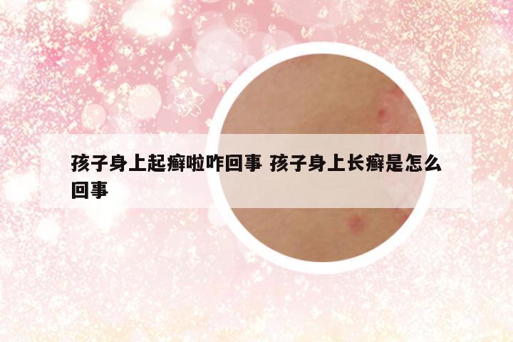 孩子身上起癣啦咋回事 孩子身上长癣是怎么回事