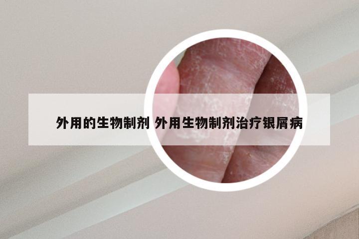 外用的生物制剂 外用生物制剂治疗银屑病