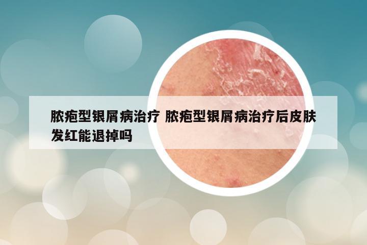 脓疱型银屑病治疗 脓疱型银屑病治疗后皮肤发红能退掉吗
