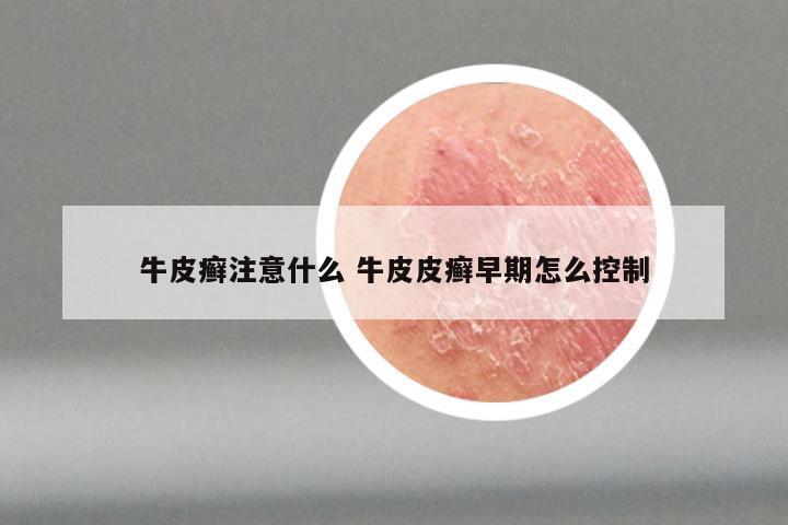 牛皮癣注意什么 牛皮皮癣早期怎么控制