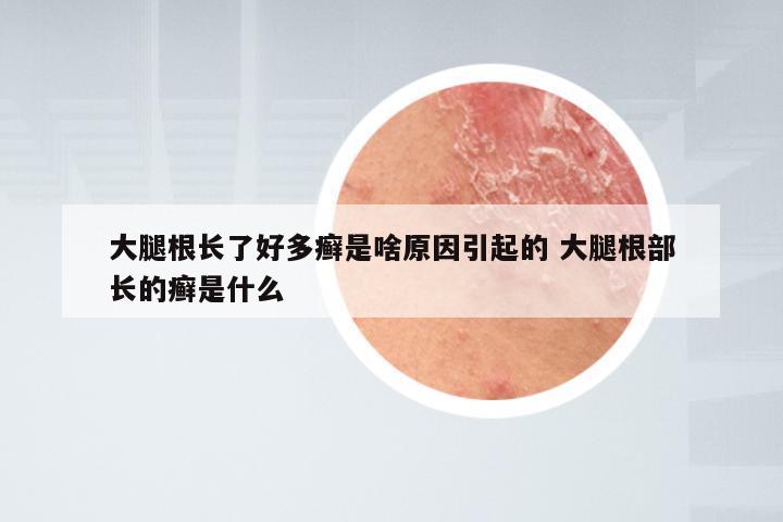 大腿根长了好多癣是啥原因引起的 大腿根部长的癣是什么