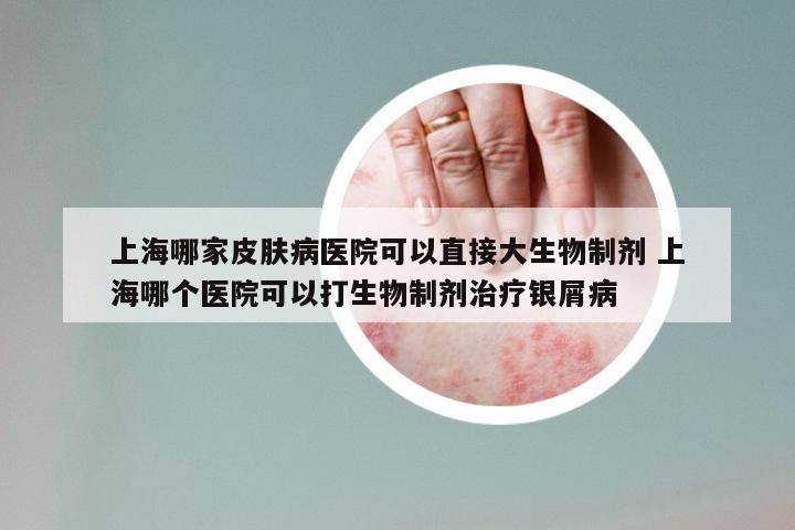 上海哪家皮肤病医院可以直接大生物制剂 上海哪个医院可以打生物制剂治疗银屑病