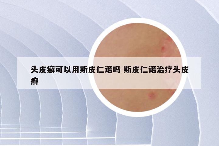 头皮癣可以用斯皮仁诺吗 斯皮仁诺治疗头皮癣