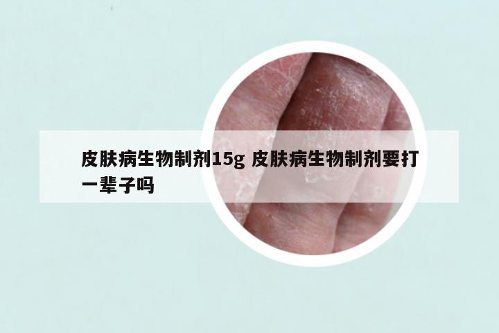 皮肤病生物制剂15g 皮肤病生物制剂要打一辈子吗