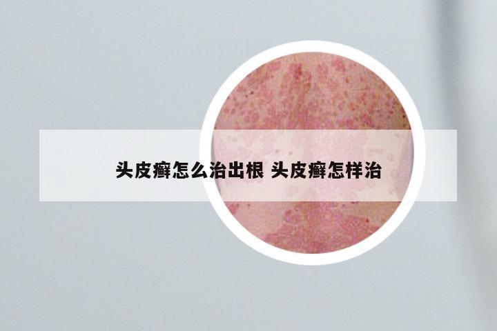头皮癣怎么治出根 头皮癣怎样治