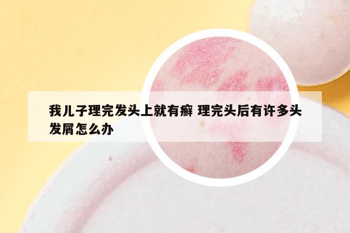 我儿子理完发头上就有癣 理完头后有许多头发屑怎么办