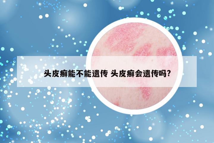 头皮癣能不能遗传 头皮癣会遗传吗?