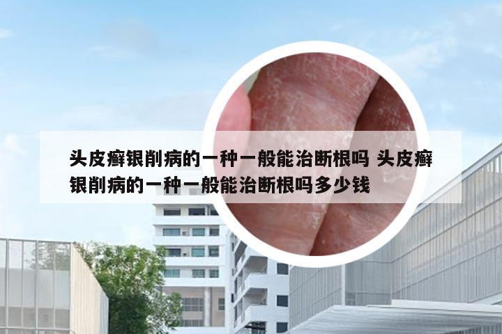 头皮癣银削病的一种一般能治断根吗 头皮癣银削病的一种一般能治断根吗多少钱