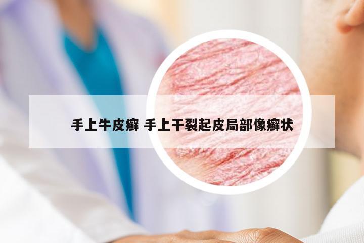 手上牛皮癣 手上干裂起皮局部像癣状