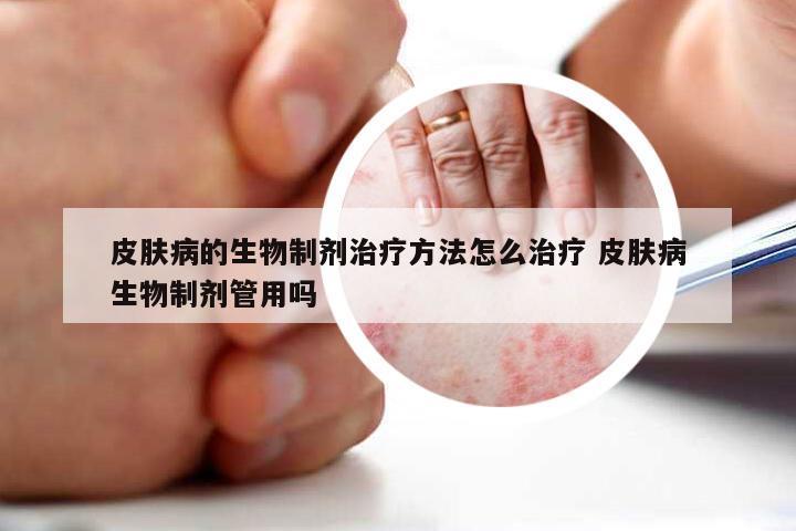 皮肤病的生物制剂治疗方法怎么治疗 皮肤病生物制剂管用吗
