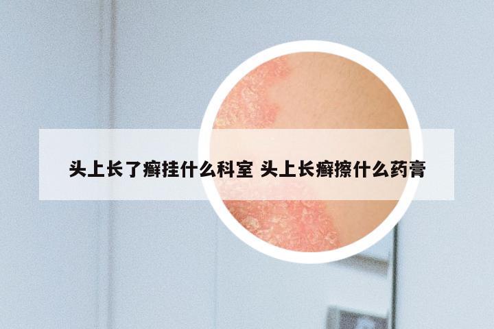 头上长了癣挂什么科室 头上长癣擦什么药膏