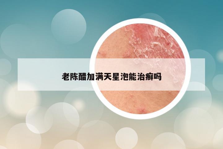 老陈醋加满天星泡能治癣吗
