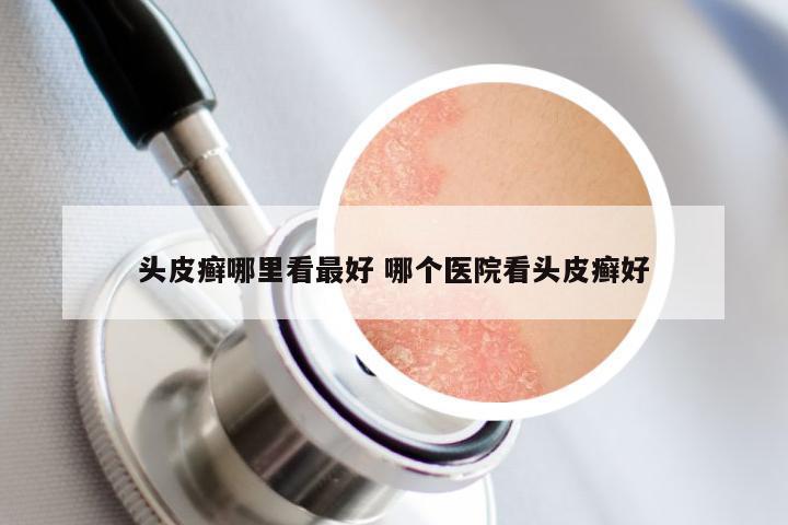 头皮癣哪里看最好 哪个医院看头皮癣好