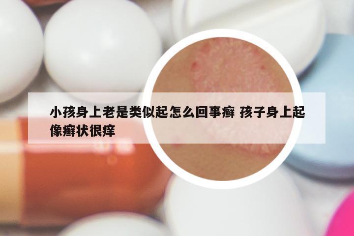 小孩身上老是类似起怎么回事癣 孩子身上起像癣状很痒