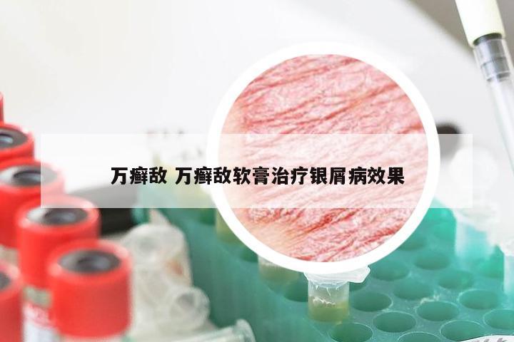 万癣敌 万癣敌软膏治疗银屑病效果