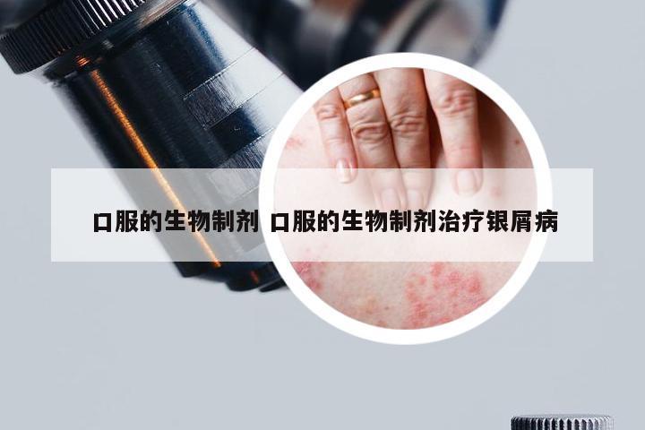 口服的生物制剂 口服的生物制剂治疗银屑病