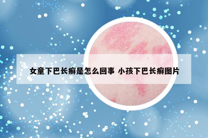 女童下巴长癣是怎么回事 小孩下巴长癣图片