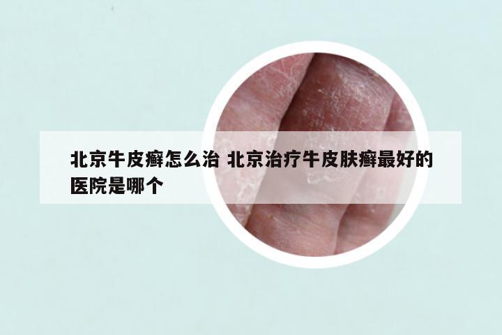 北京牛皮癣怎么治 北京治疗牛皮肤癣最好的医院是哪个