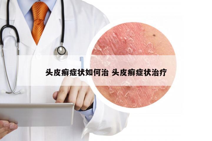 头皮癣症状如何治 头皮癣症状治疗