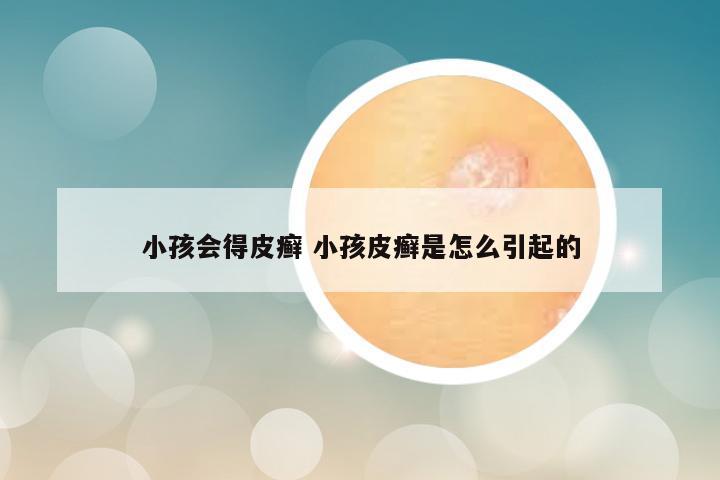 小孩会得皮癣 小孩皮癣是怎么引起的