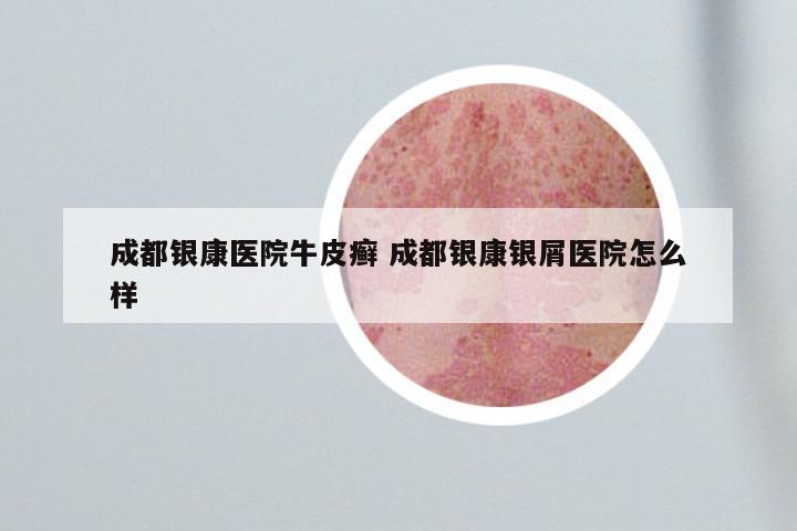成都银康医院牛皮癣 成都银康银屑医院怎么样