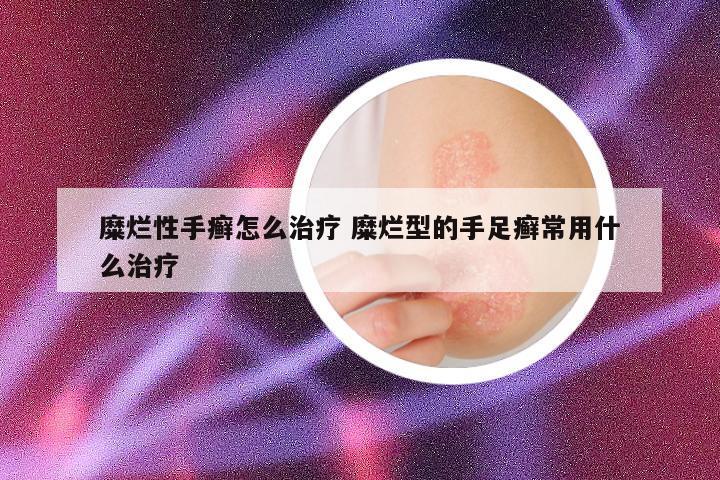 糜烂性手癣怎么治疗 糜烂型的手足癣常用什么治疗