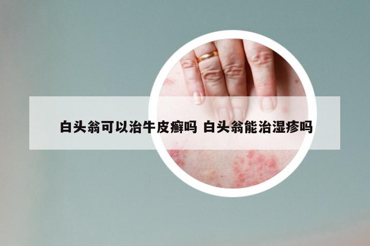 白头翁可以治牛皮癣吗 白头翁能治湿疹吗