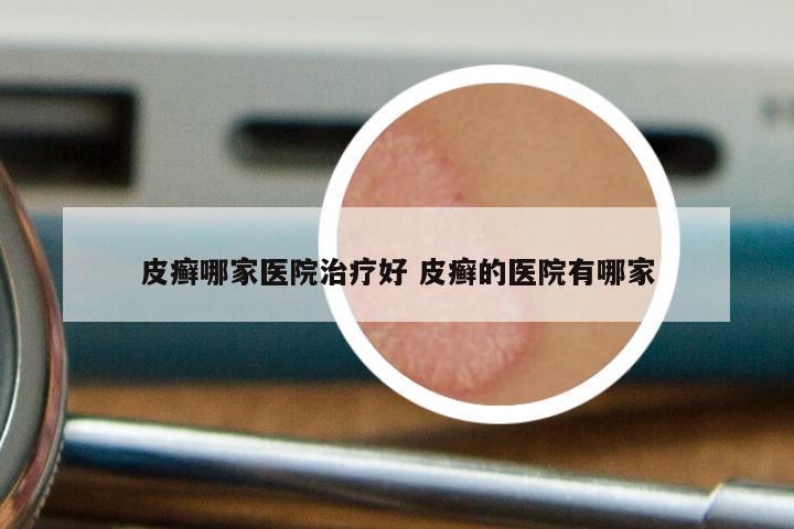 皮癣哪家医院治疗好 皮癣的医院有哪家